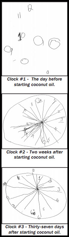 Improvement in drawing a clock after Coconut Oil in Alzheimer's